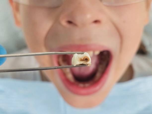 Best Emergency Broken Tooth Repair in Buda, TX